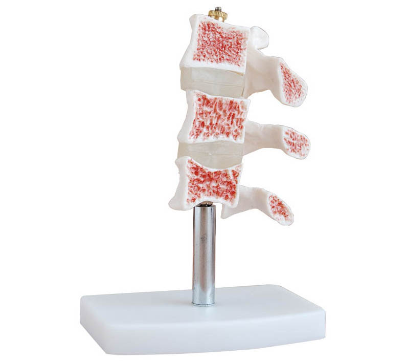 HL/XC134 骨质疏松模型(脊椎典型病变模型)