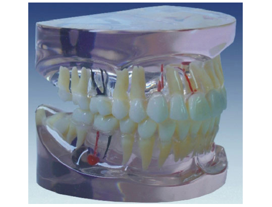 HL/Y10011-1 透明牙体病理模型