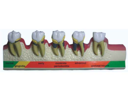 HL/Y10014 牙周病分类模型